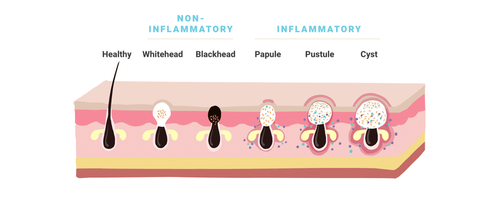 acne Illustration@2x